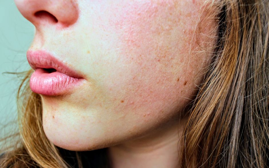 Bí quyết chọn sản phẩm trị nám hiệu quả từ chuyên gia Da liễu